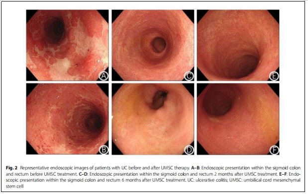 UC-MSCs移植2个月，73.2%溃疡性结肠炎患者达到临床缓解，43.9%患者经历粘膜愈合！