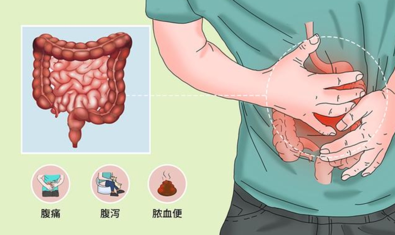 溃疡性结肠炎