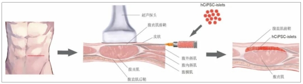 糖尿病临床试验